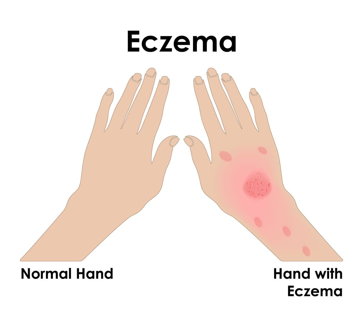 Tipos de Eczema: No Es Todo la Misma Afección