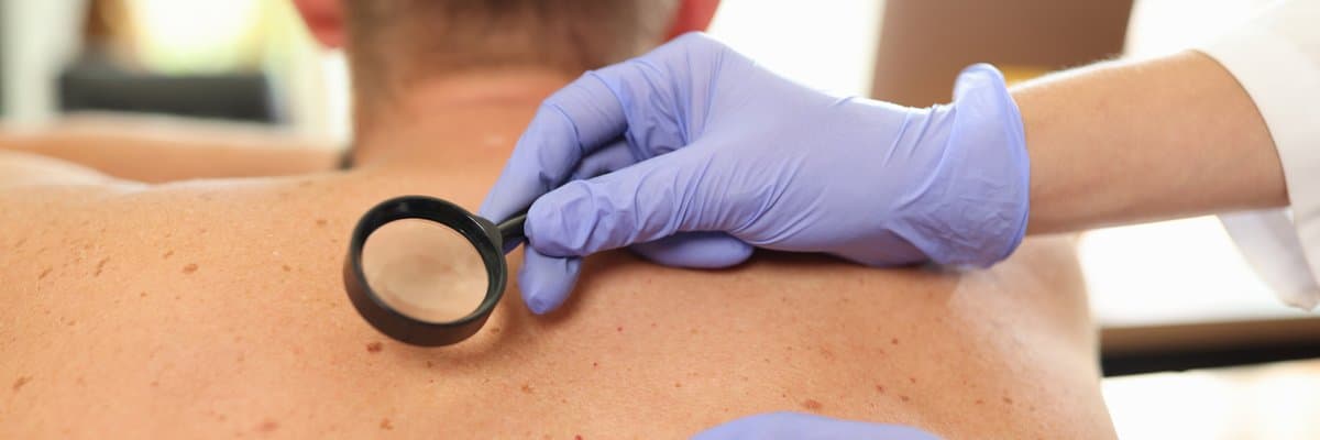 Lentigo vs. Melanoma: Cuándo Preocuparse