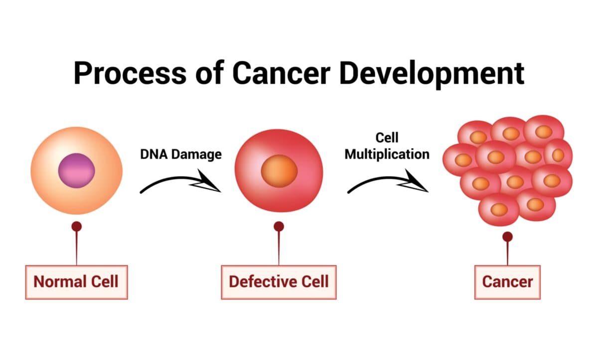 Etapas del Melanoma: Comprendiendo Tu Pronóstico