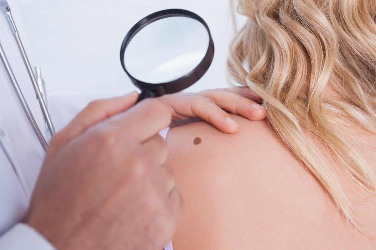 La Regla ABCDE para el Monitoreo de la Piel (Guía para Principiantes)