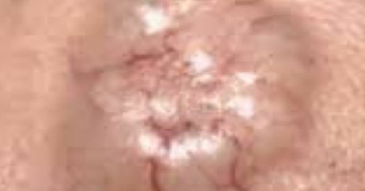 Carcinoma de Células Basales: El Cáncer 'Bueno' Que Aún Destruye Caras