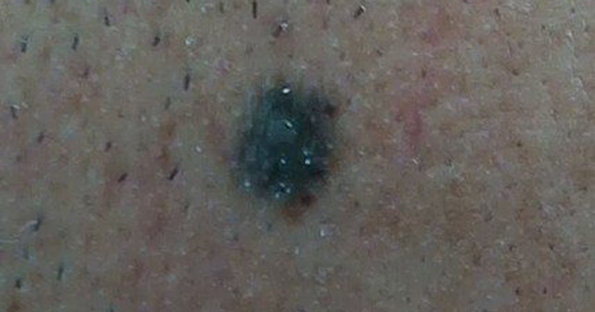 blue-nevus-complete-guide