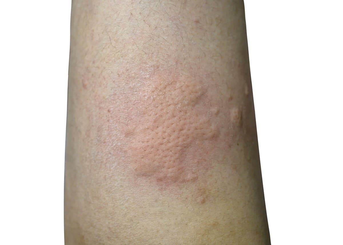 cellulitis-complete-guide