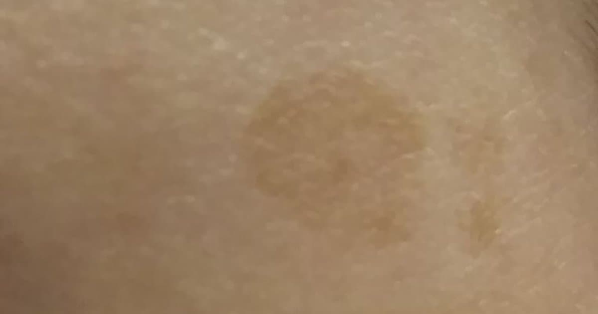 cherry-angioma-complete-guide