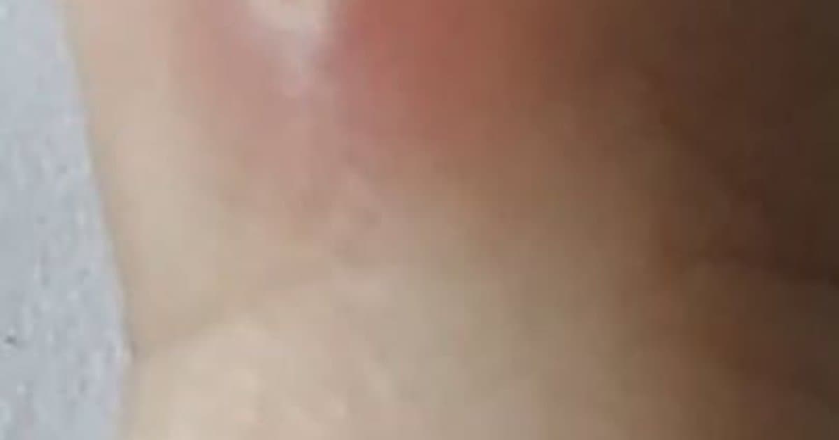 Verrugas Comunes: Los Crecimientos Cutáneos Persistentes Que Siguen Regresando