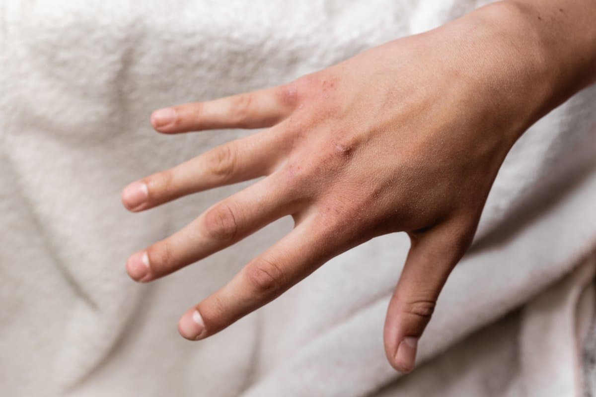 Léntigos vs Cáncer de Piel: Cómo Diferenciarlos