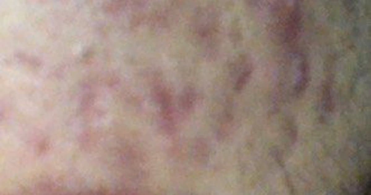 cystic-acne-complete-guide