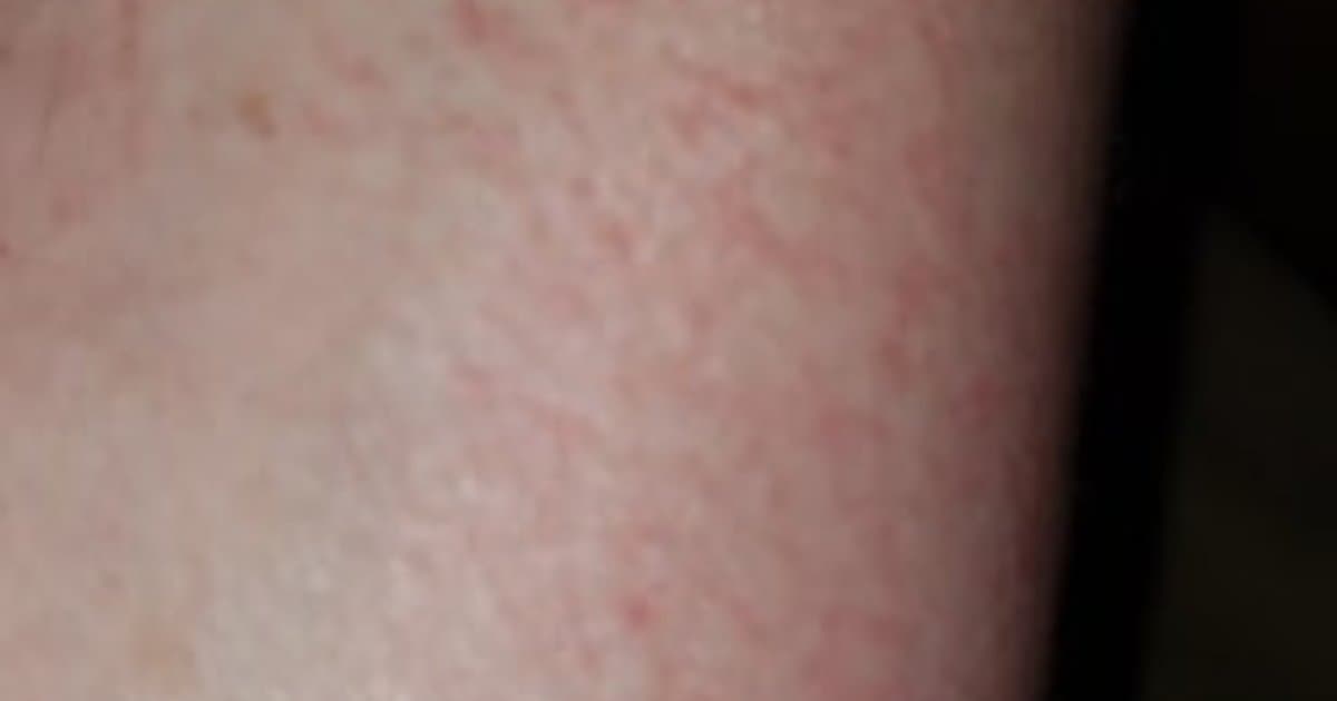 Dermatitis de Contacto: Cuando Tu Piel Reacciona al Mundo que Te Rodea