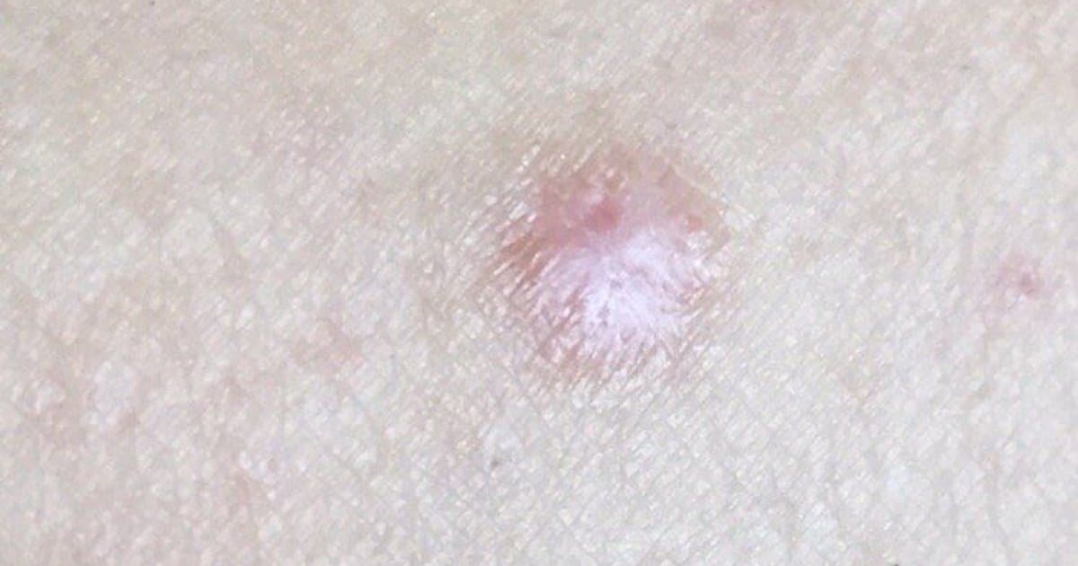 Dermatofibroma: El Nódulo Cutáneo Firme Que Se Hunda Cuando Lo Apretes