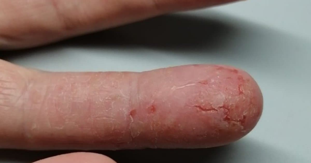 Eczema (Dermatitis Atópica): El Picor Crónico Que Roba Sueño y Cordura