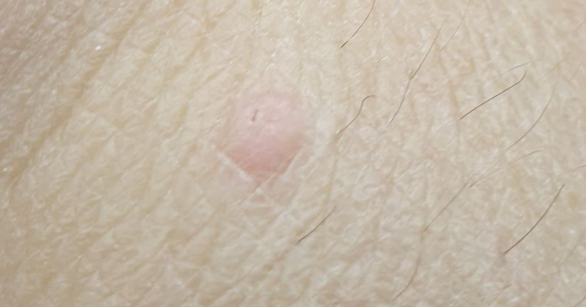 flat-warts-complete-guide