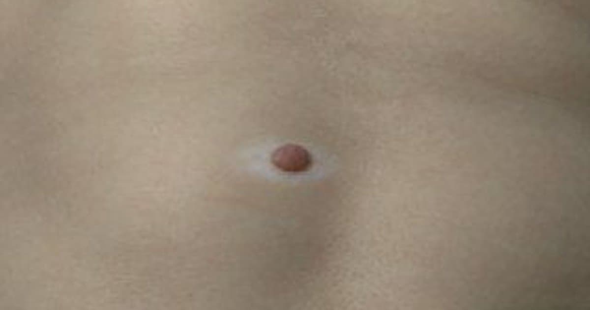 Nevus Halo: Cuando Tu Lunar Desarrolla un Anillo Blanco Alrededor