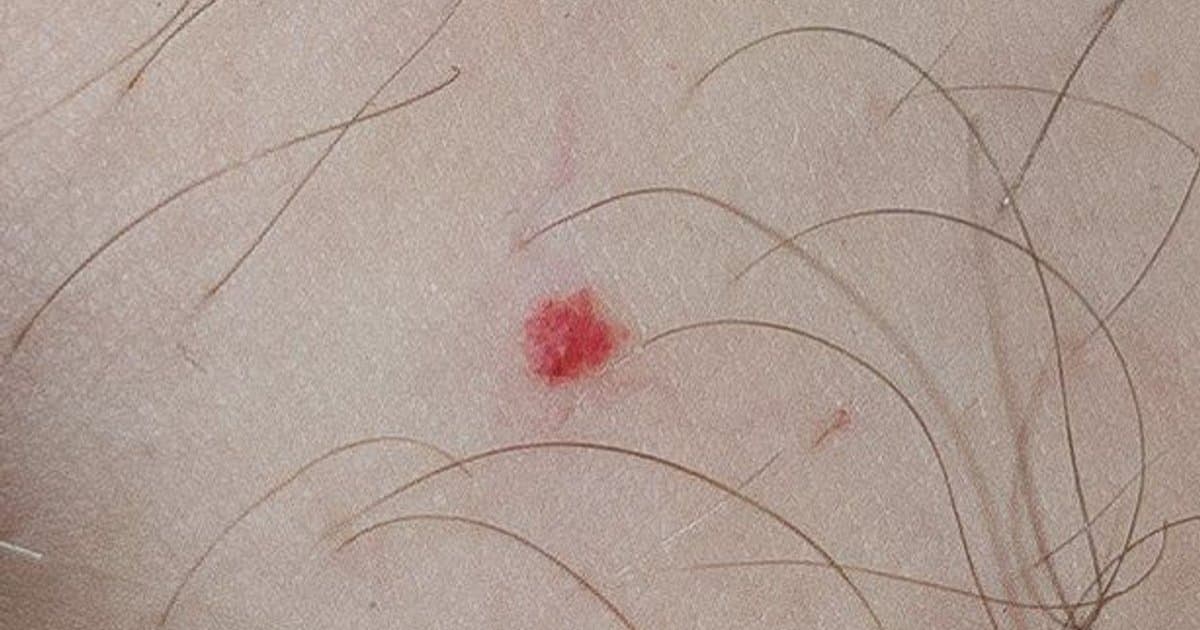 Hemangioma: Comprendiendo las Manchas Vasculares en los Lactantes