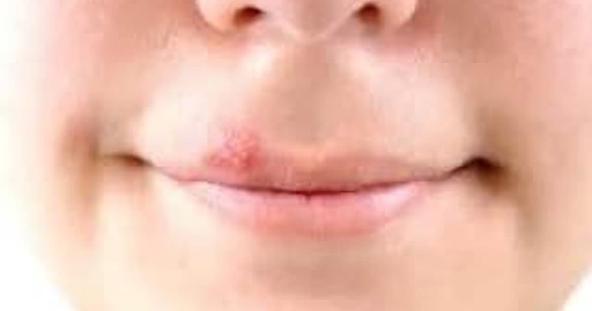 Herpes Simplex: Separando los Hechos Médicos del Estigma Social