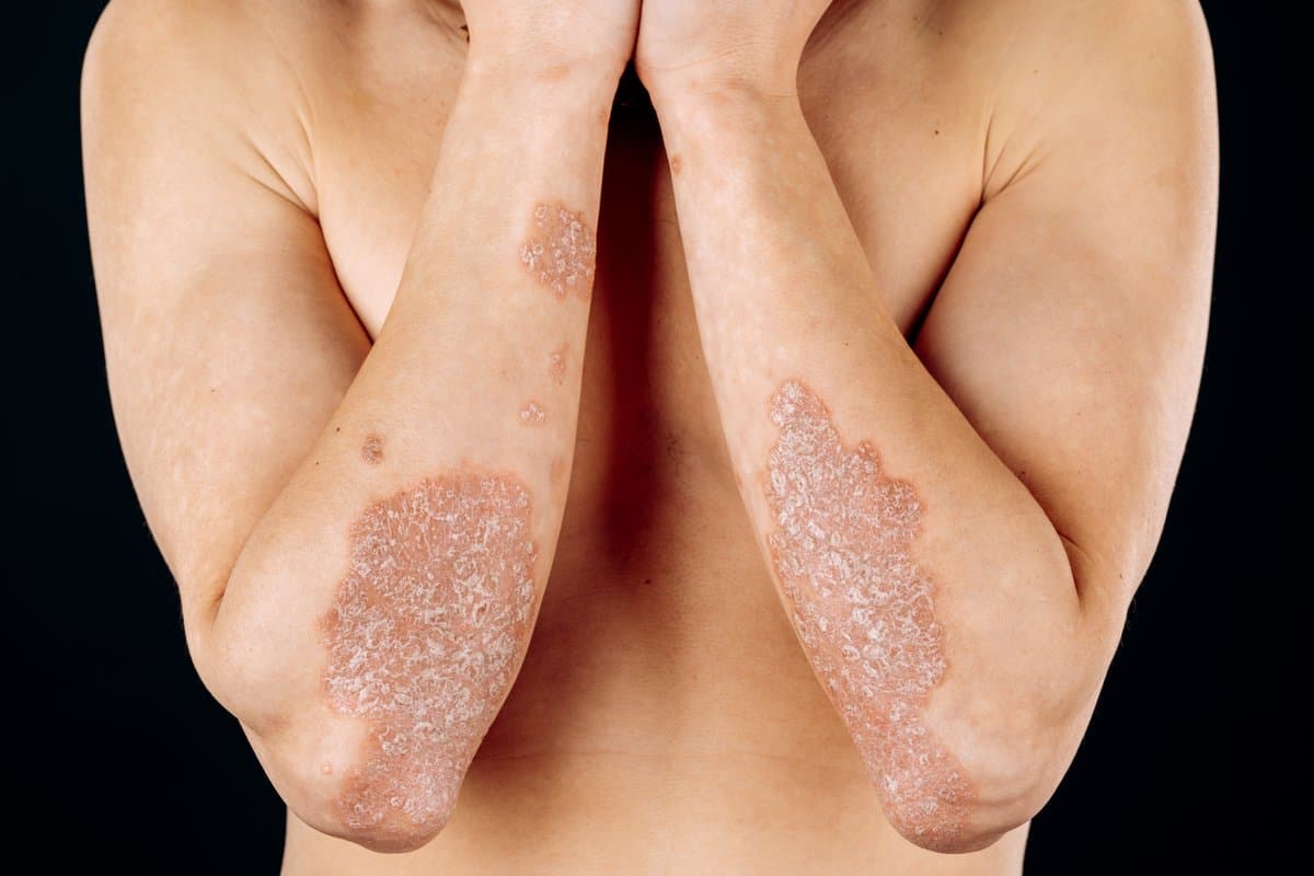 Types of Impetigo