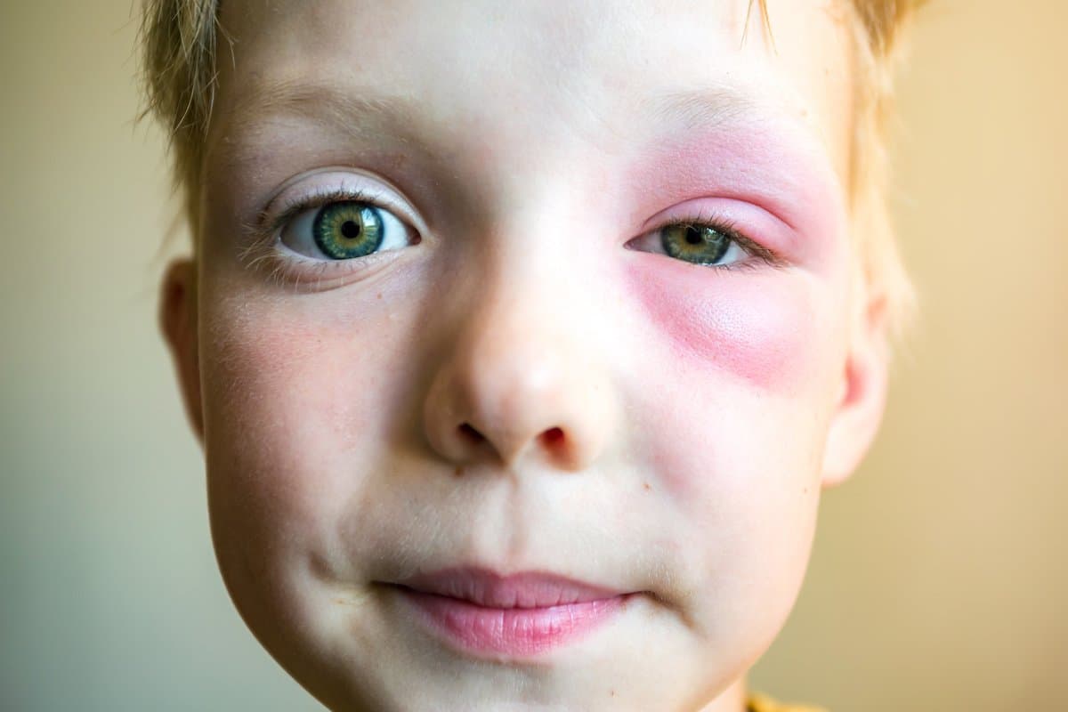 impetigo-complete-guide