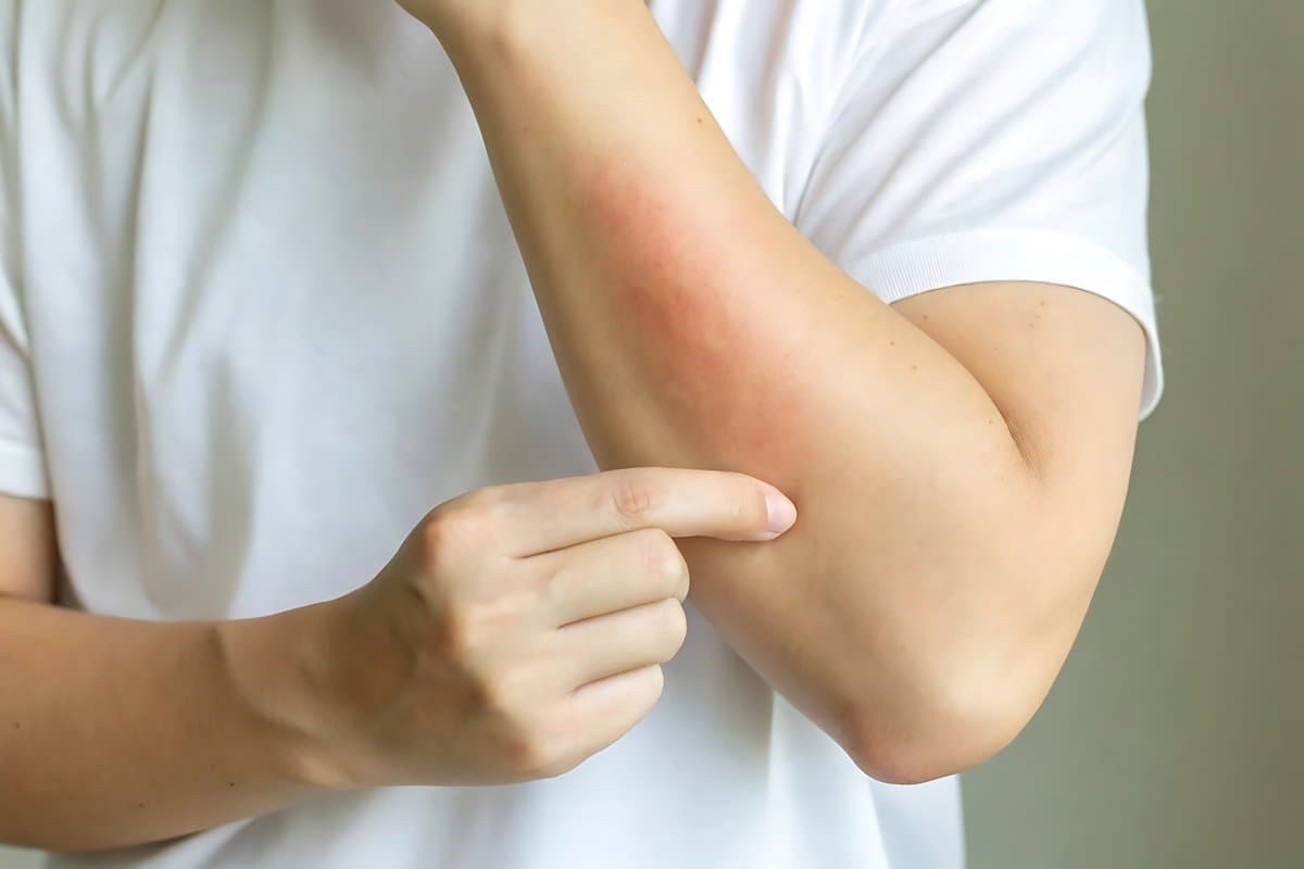 Erupción Picazón Que Vuelve: Lo Que Tu Piel Te Está Diciendo