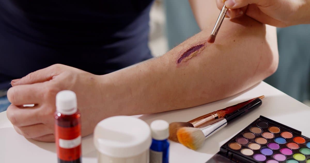 What Is Kaposi Sarcoma?