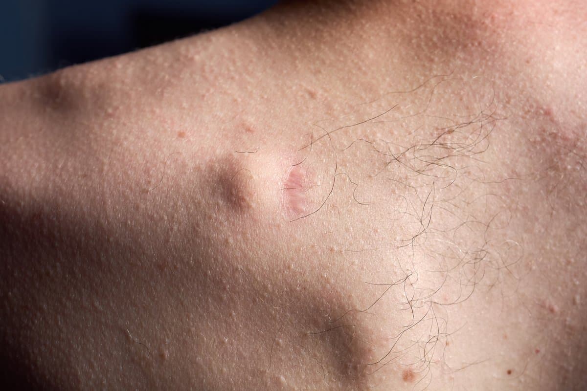 What Is Keratoacanthoma?