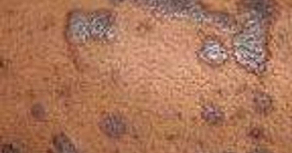 Liquen plano: Causas, Reconocimiento y Tratamiento