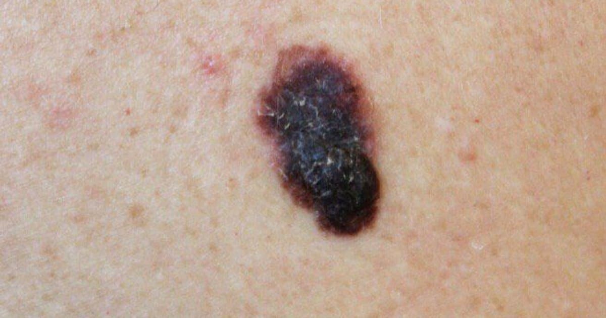 Melanoma: El Cáncer de Piel Más Mortal que Debes Conocer