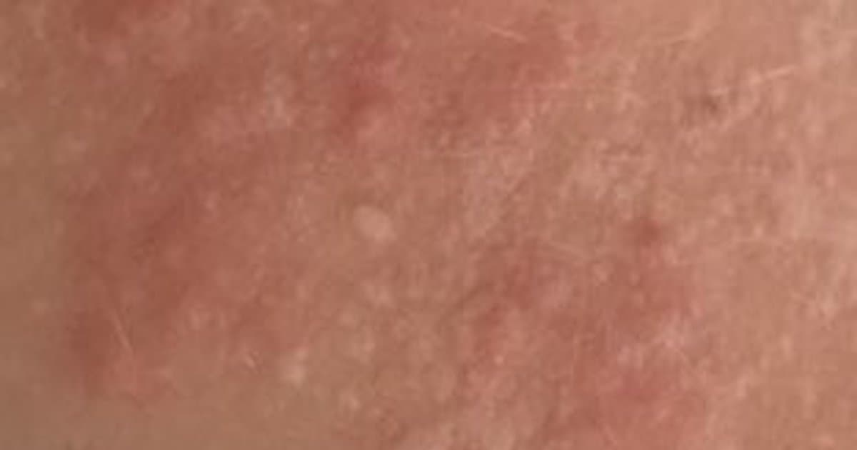 Milia: Comprendiendo los Pequeños Quistes Blancos Bajo Tu Piel