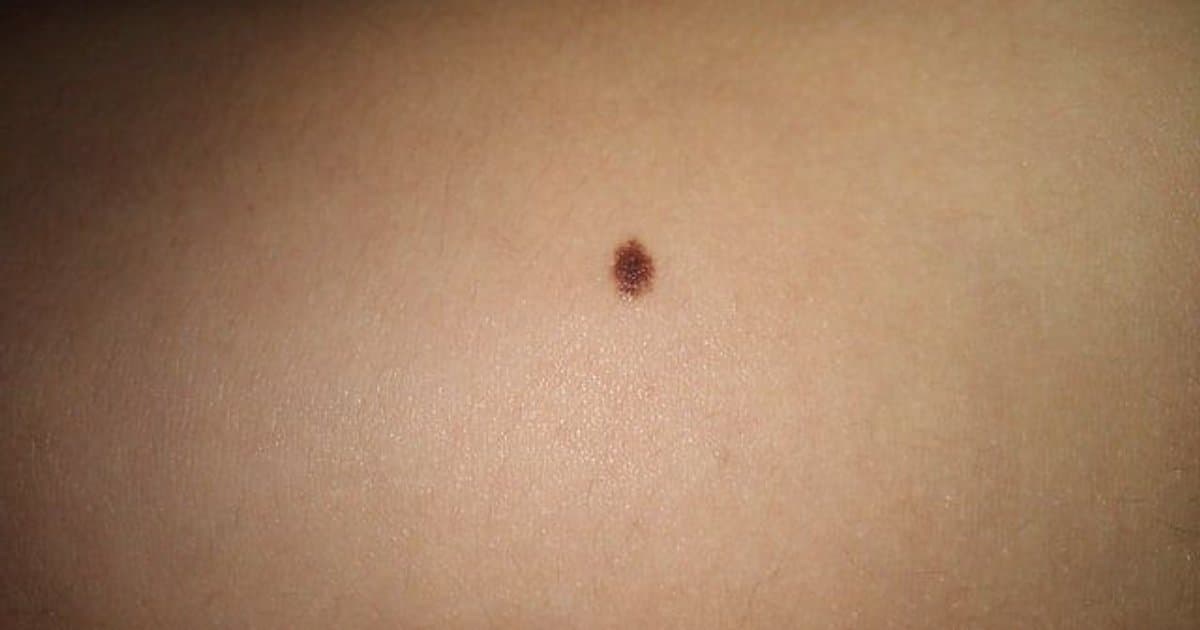 Lunares: Una Guía Completa para Entender los Nevos Cutáneos