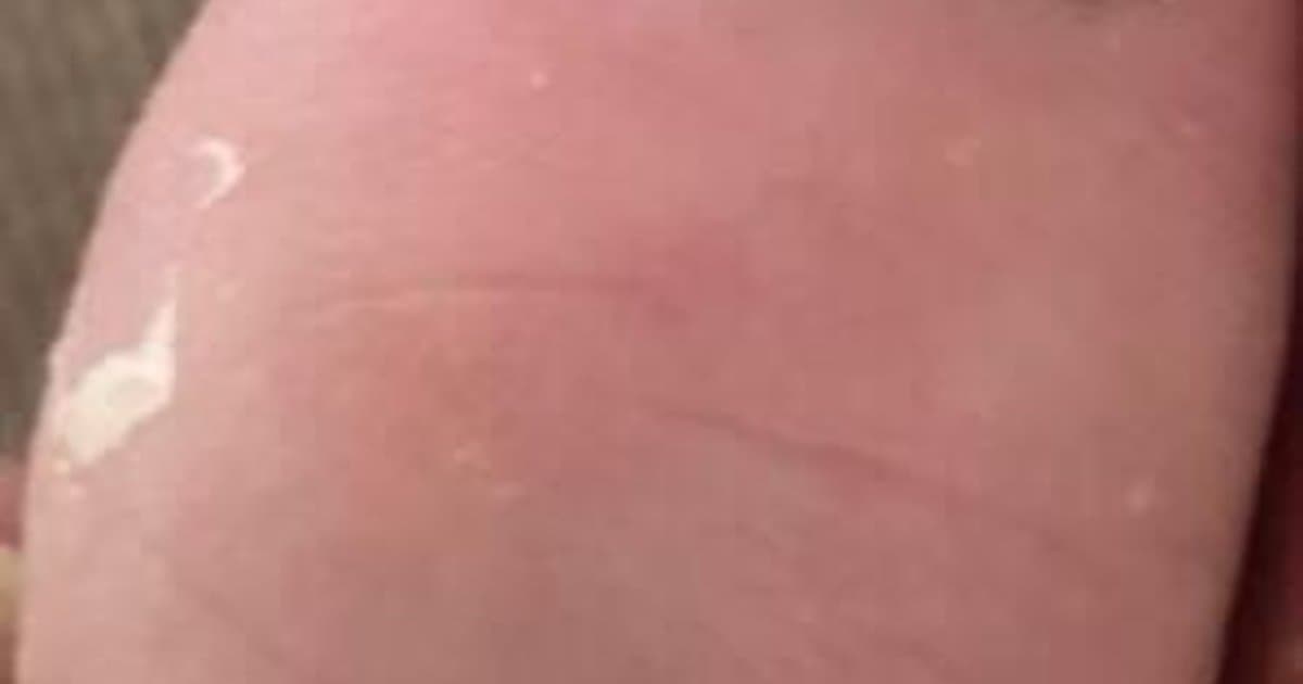 Hongos en las Uñas (Onicomicosis): La Infección Persistente Que Pone a Prueba Tu Paciencia