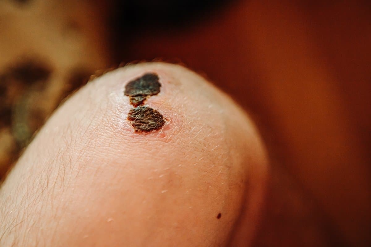 nodular-melanoma-complete-guide