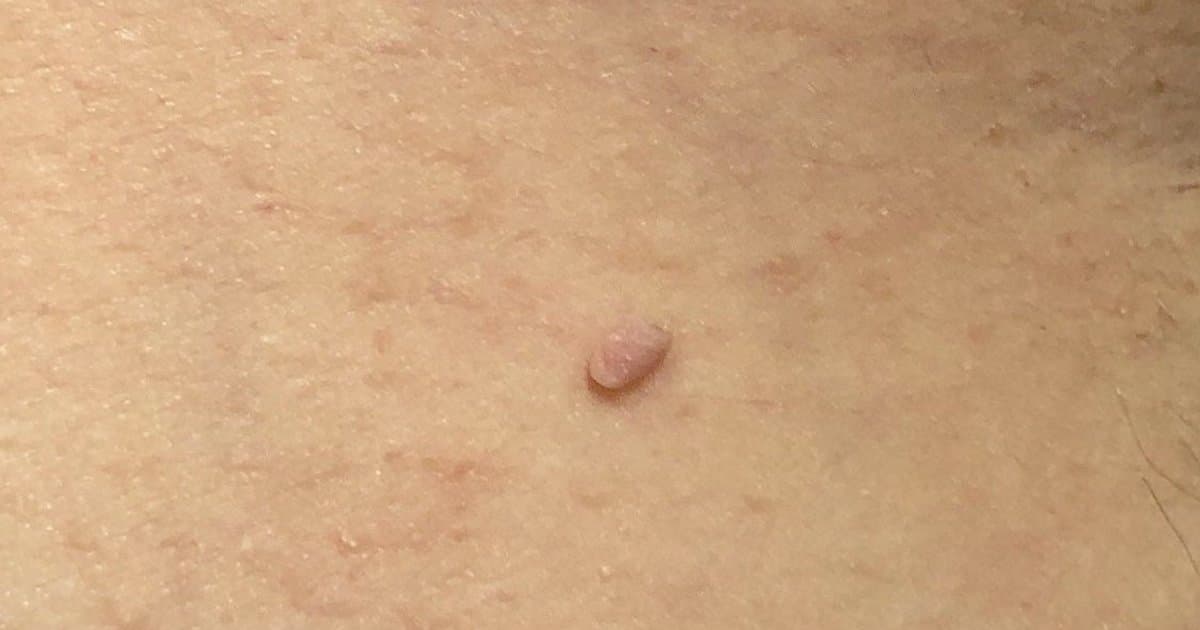 skin-tags-complete-guide