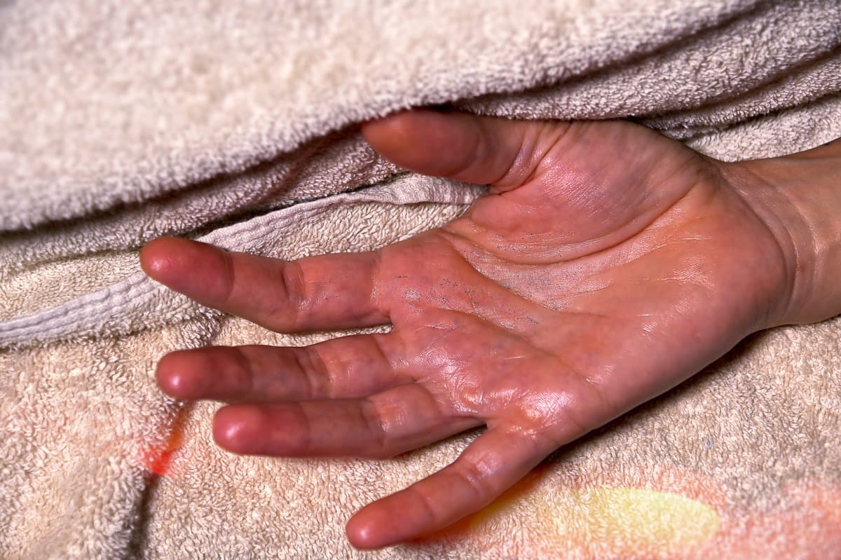 ¿Marcas oscuras después del acné o una lesión? Entendiendo la Hiperpigmentación Postinflamatoria