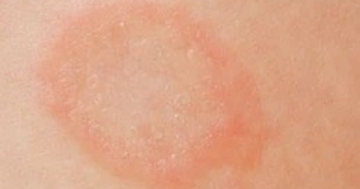 Pitiriasis Rosada: Causas, Curso y Tratamiento