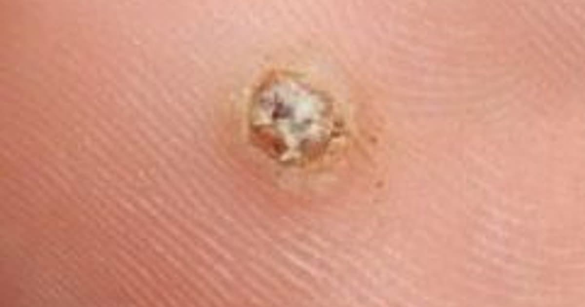 plantar-wart-complete-guide