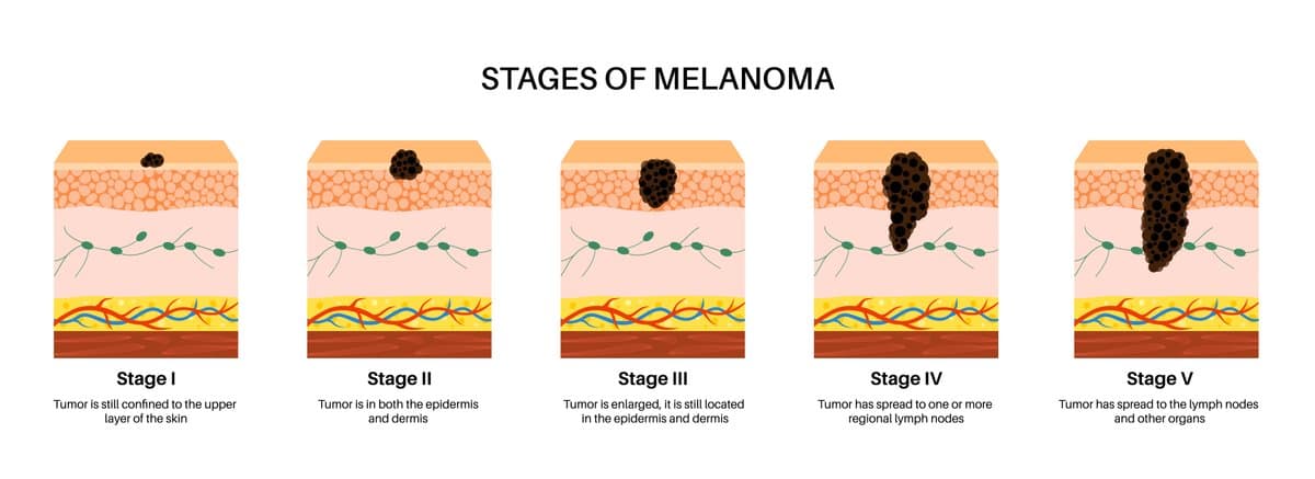 ¿Qué es la Psoriasis y por qué sigue regresando?