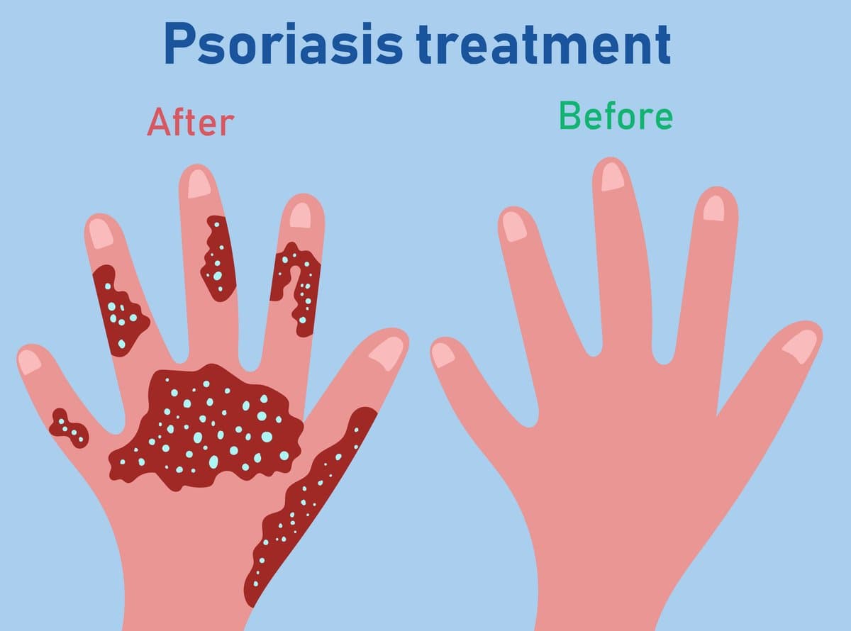 Tipos de Psoriasis: Desde Placas Comunes hasta Formas Potencialmente Mortales