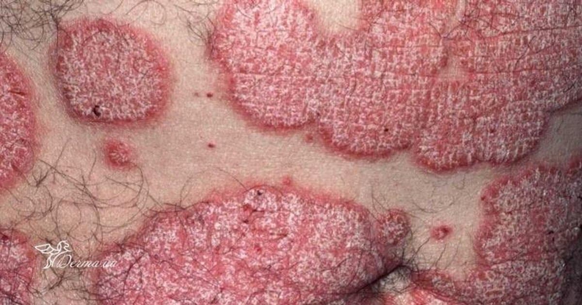 Psoriasis: Viviendo con la Condición Crónica de la Piel que Nunca Realmente Desaparece