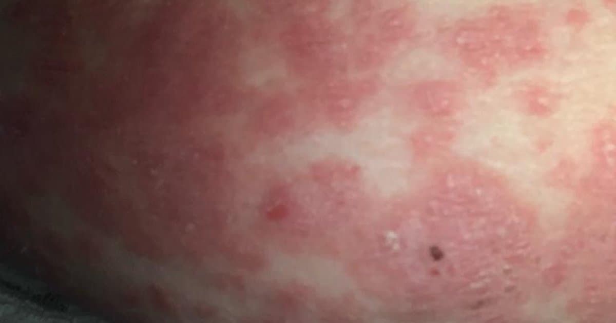 pustular-psoriasis-complete-guide