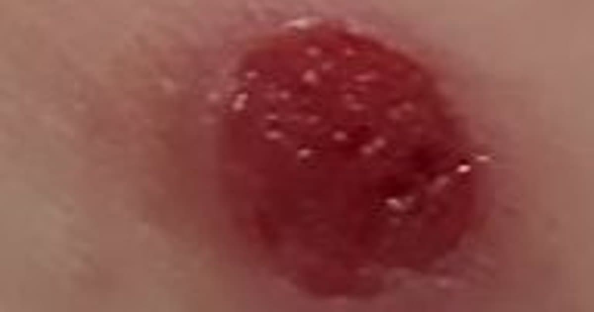 pyogenic-granuloma-complete-guide