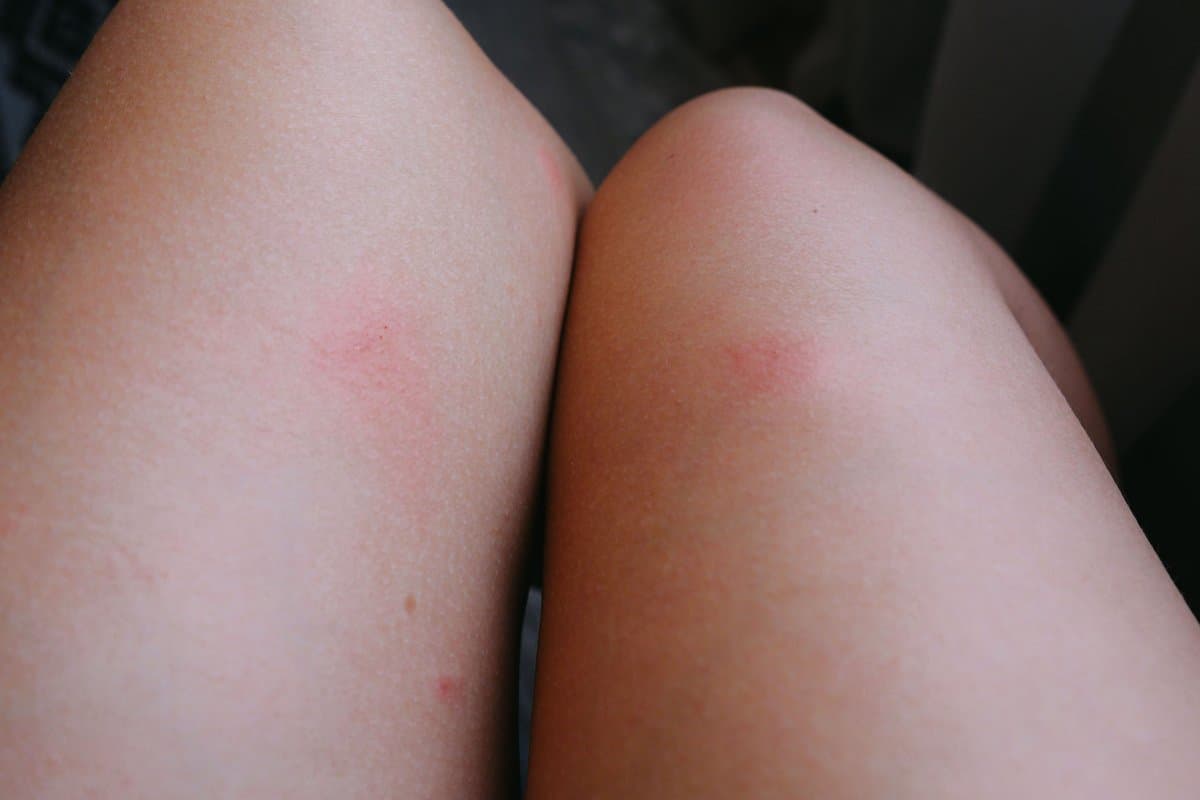 ¿Piel áspera y con bultos en los brazos? Podría ser esta condición