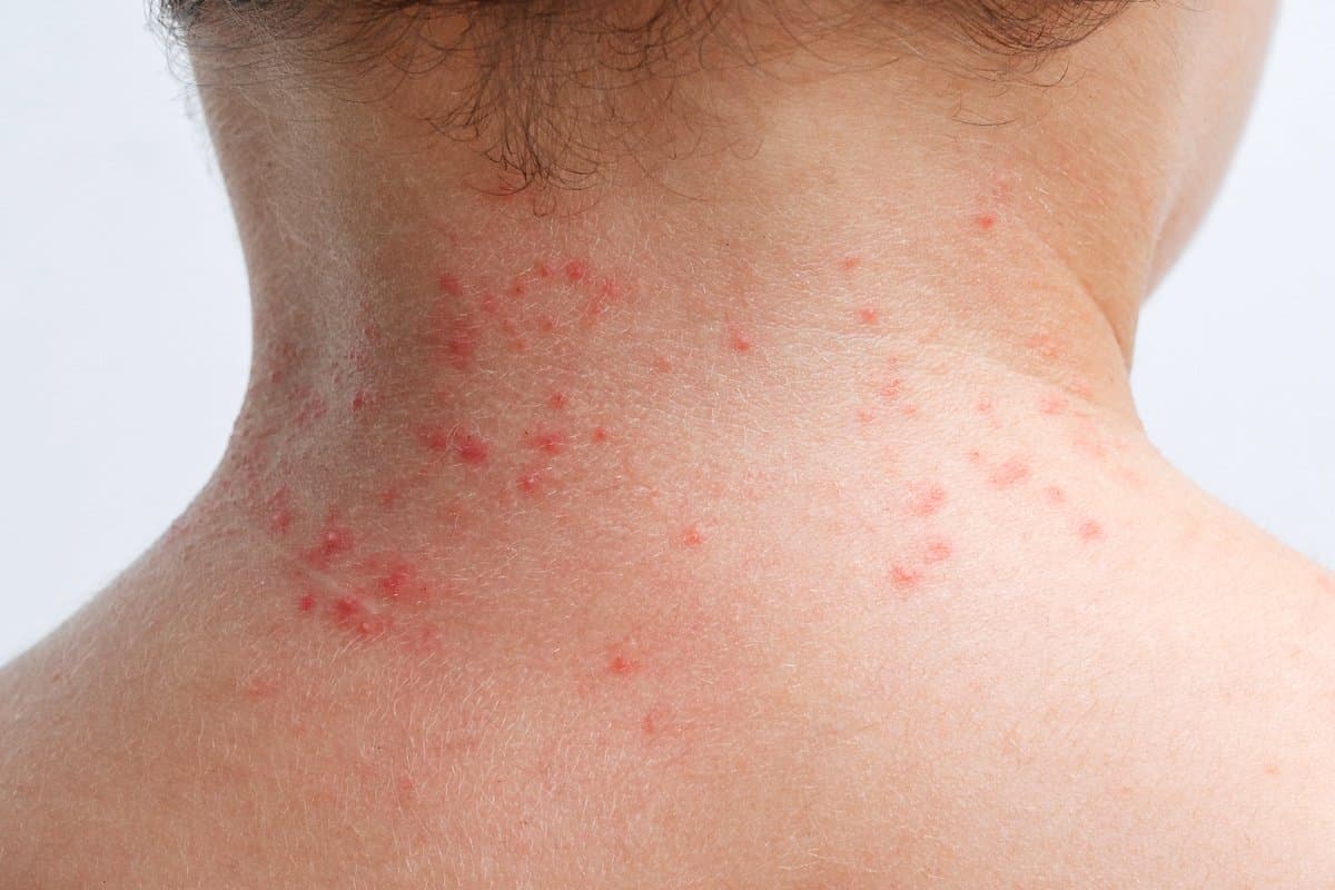 Manchas Rojas en la Piel: 12 Causas Comunes (Con Imágenes)