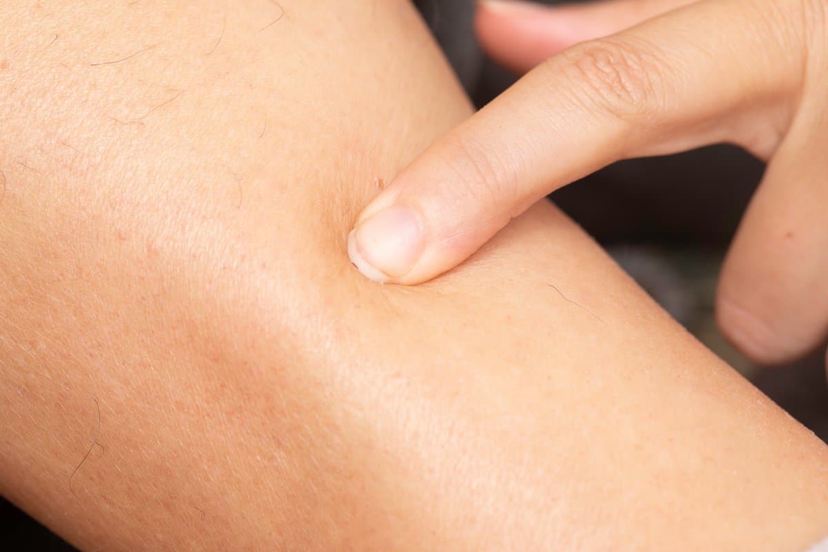 ¿Piel escamosa en tu cara? Causas y cómo solucionarlo rápidamente