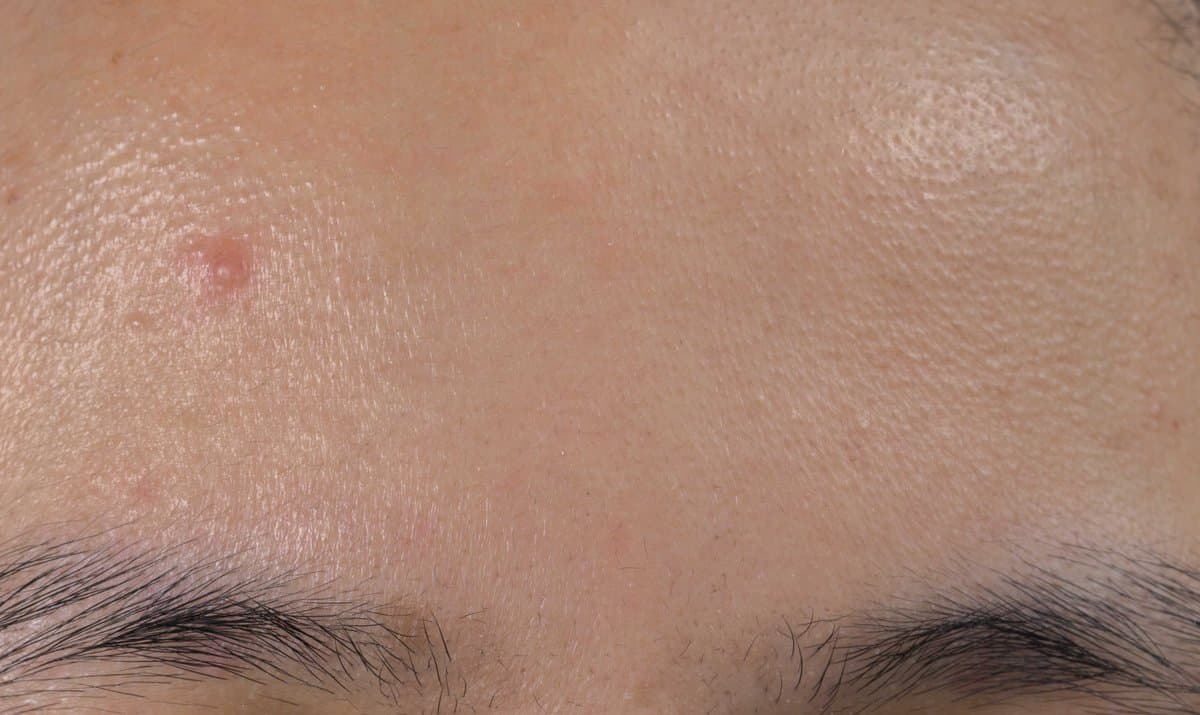 Exfoliación Química vs Física para la Textura