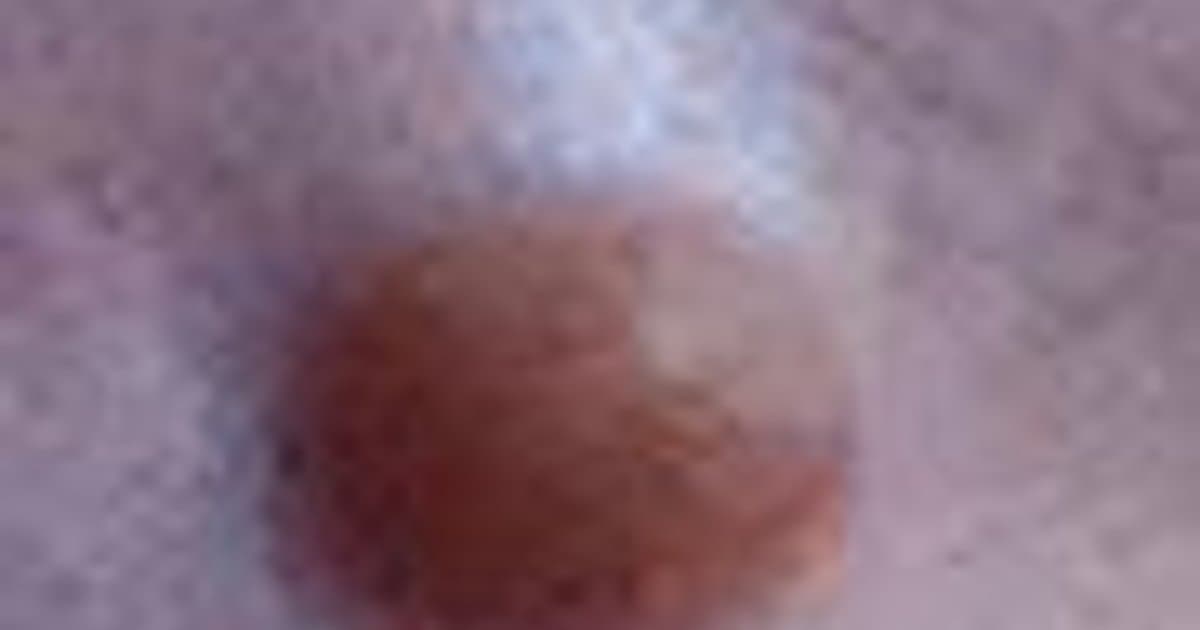 Nevus Spitz: El Lunar Inusual Que Puede Imitar el Melanoma