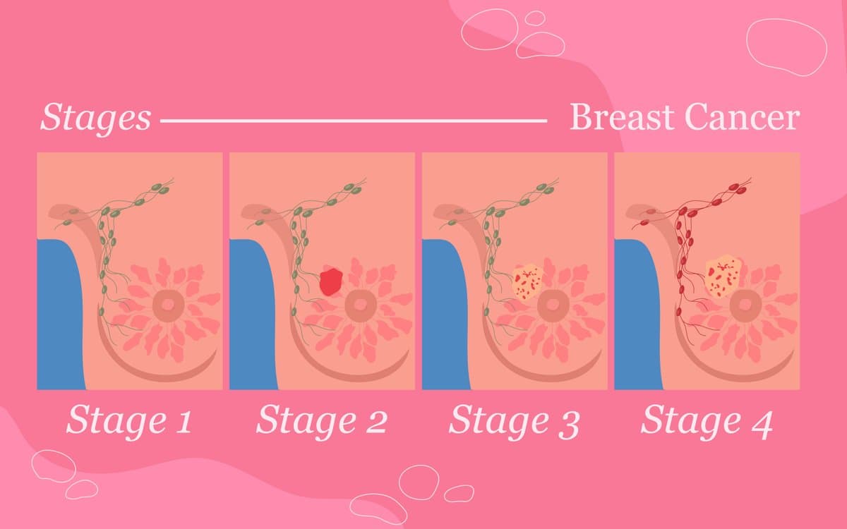 Estadificación y Pronóstico: Por Qué Importan el Tamaño y la Profundidad