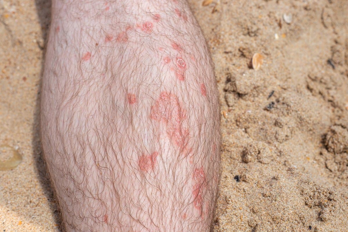 Caspa vs Cuero Cabelludo Seco: No Son Lo Mismo