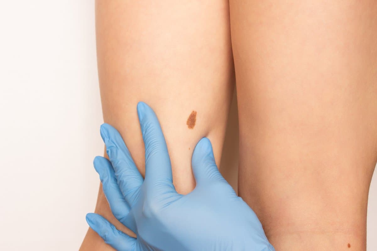 What Is Superficial Spreading Melanoma?