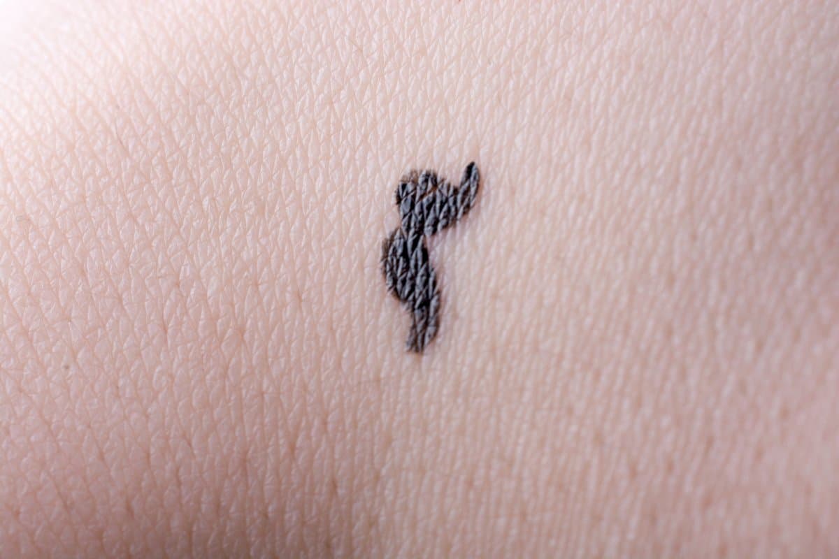 superficial-spreading-melanoma-complete-guide