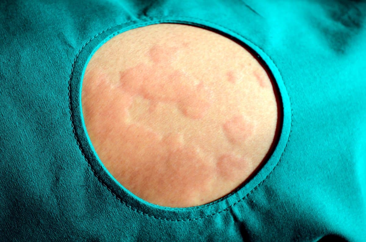 Tinea Corporis (Tiña): Causas, Síntomas y Tratamiento