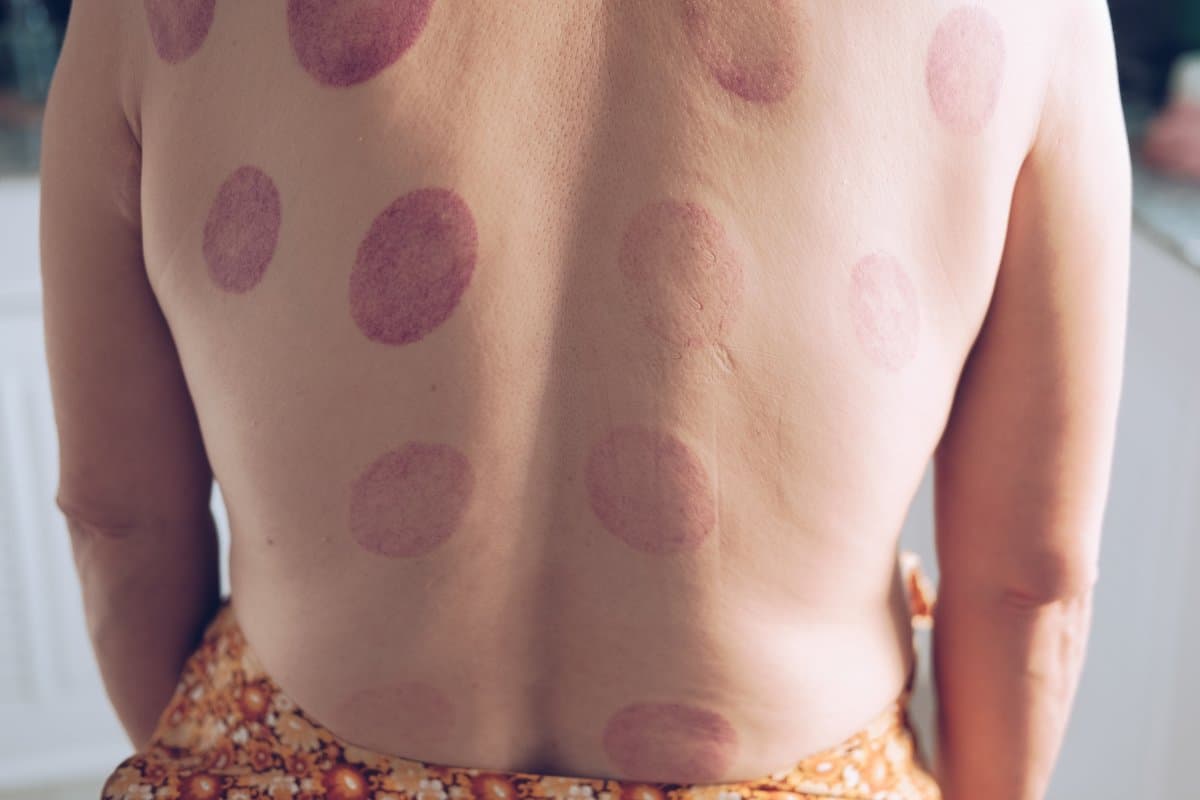 How Does Tinea Versicolor Look?