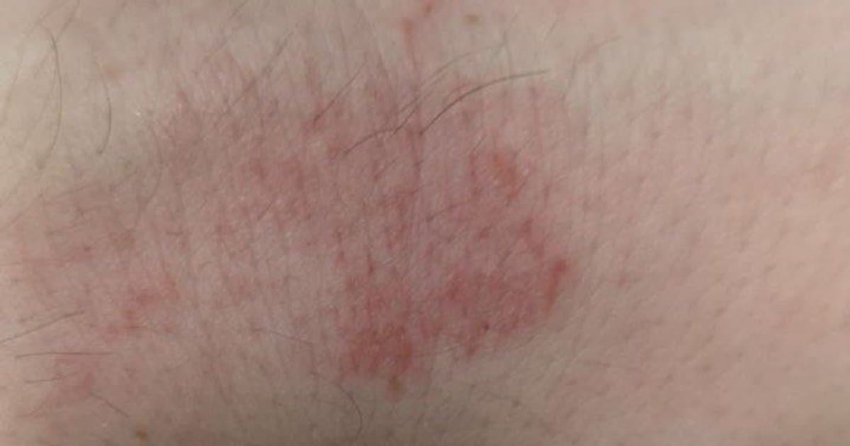 Urticaria (Ronchas): Cuando Tu Piel Erupta Sin Advertencia